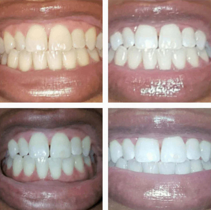 Teeth Whitening Pen