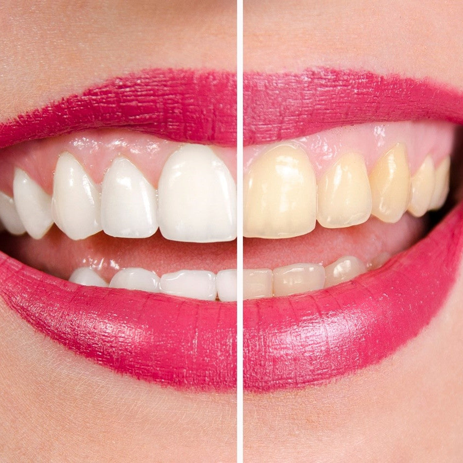 Teeth Whitening Pen
